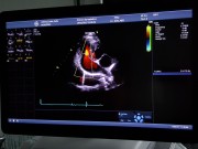 Aortastenose - og litt spondylose - spørsmål og svar