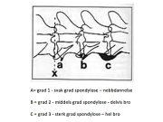 Kartleggingsprosjekt Spondylose 